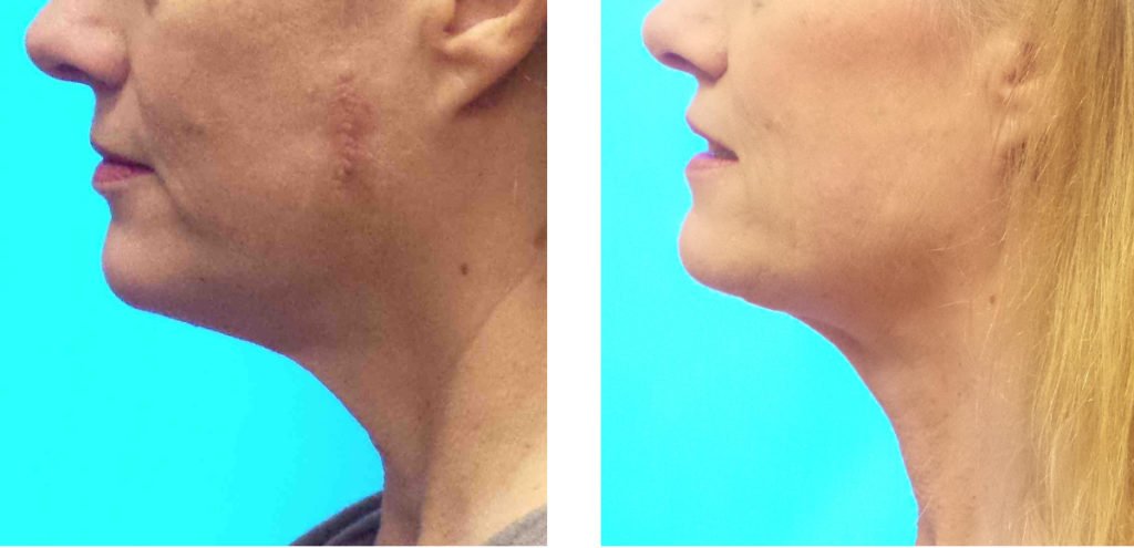 Chin Lift Photos - Before & After Pictures - Bozeman MT - Dr. McDaniel