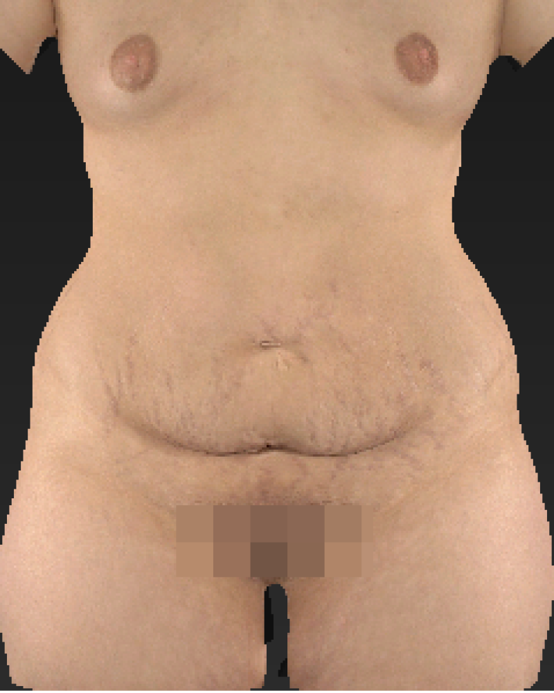 30 year old patient before bilatreal breast augmentation, lipoabdominoplasty and liposuction of flanks and posterior trunk