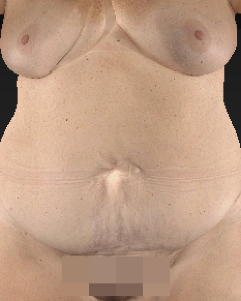 48 year old patient before lipoabdominoplasty with flank and posterior trunk liposuction