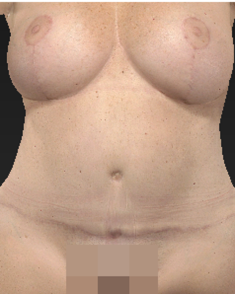 9 months post-op