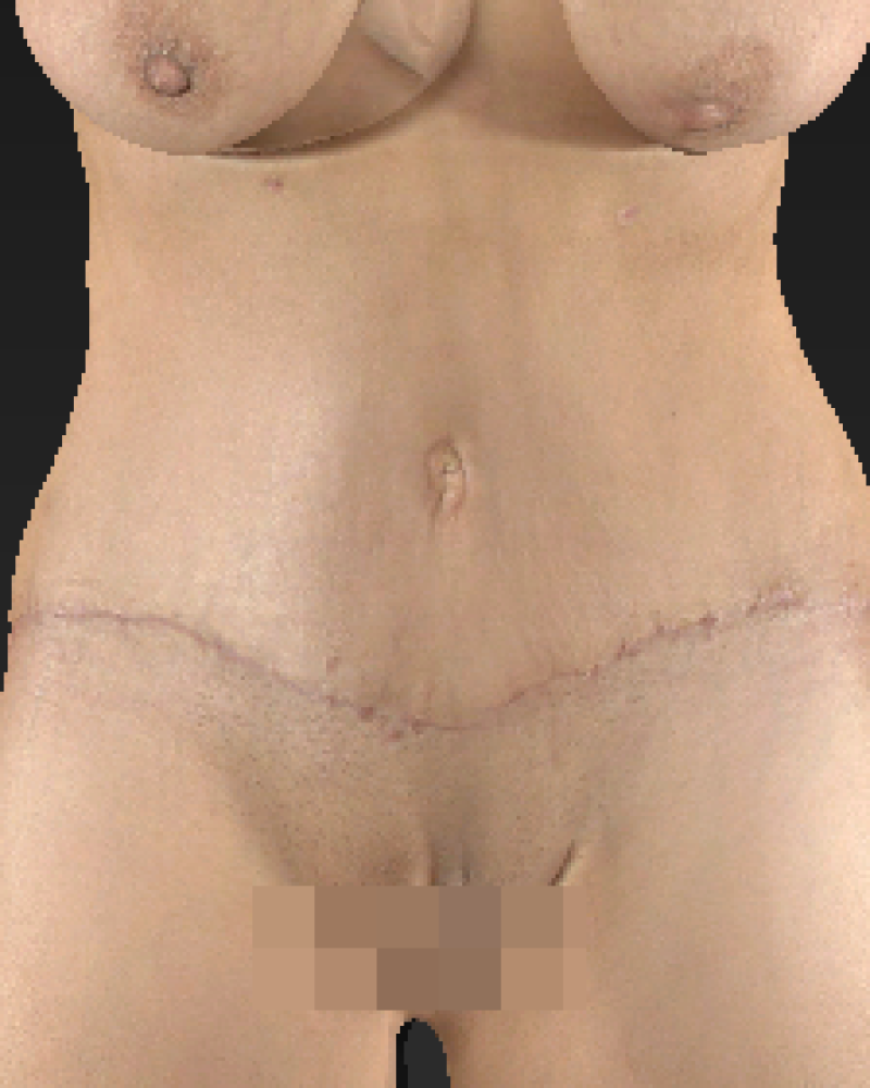 2 months post-op