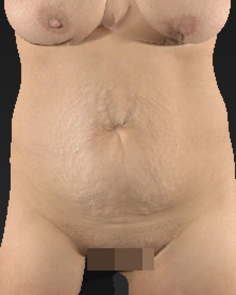 47 year old patient before lipoabdominoplasty and flank liposuction