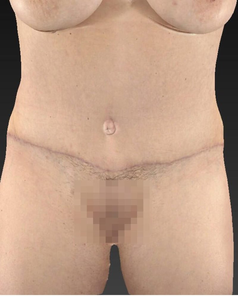 2 months post-op