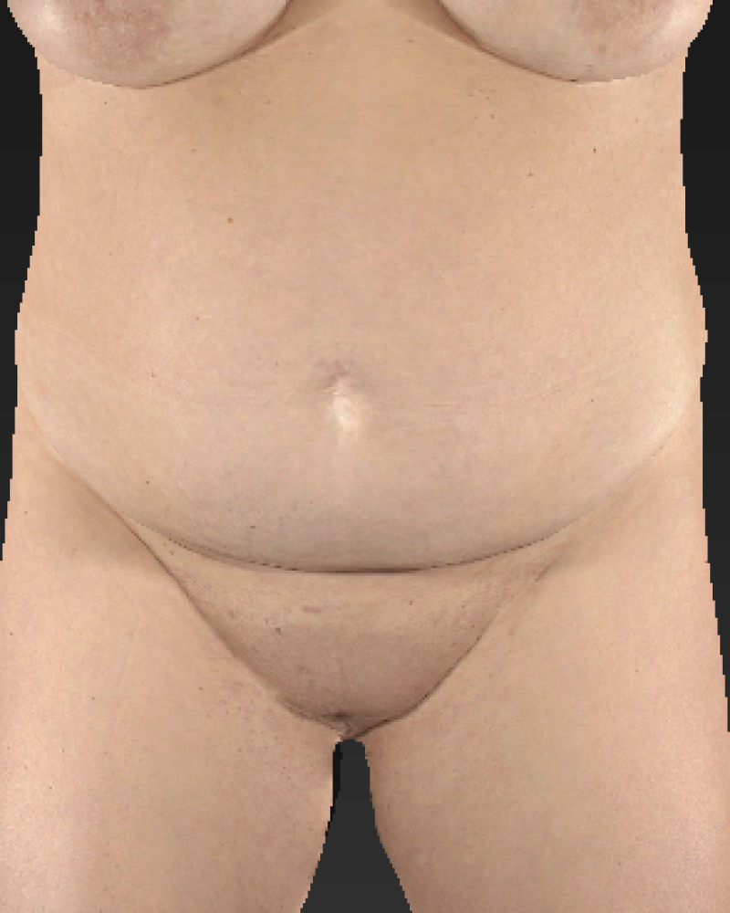 35 year old patient before lipoabdominoplasty