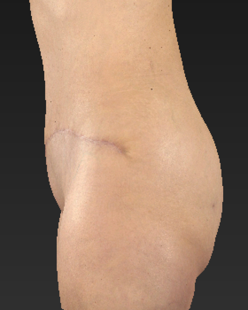 6 months post-op