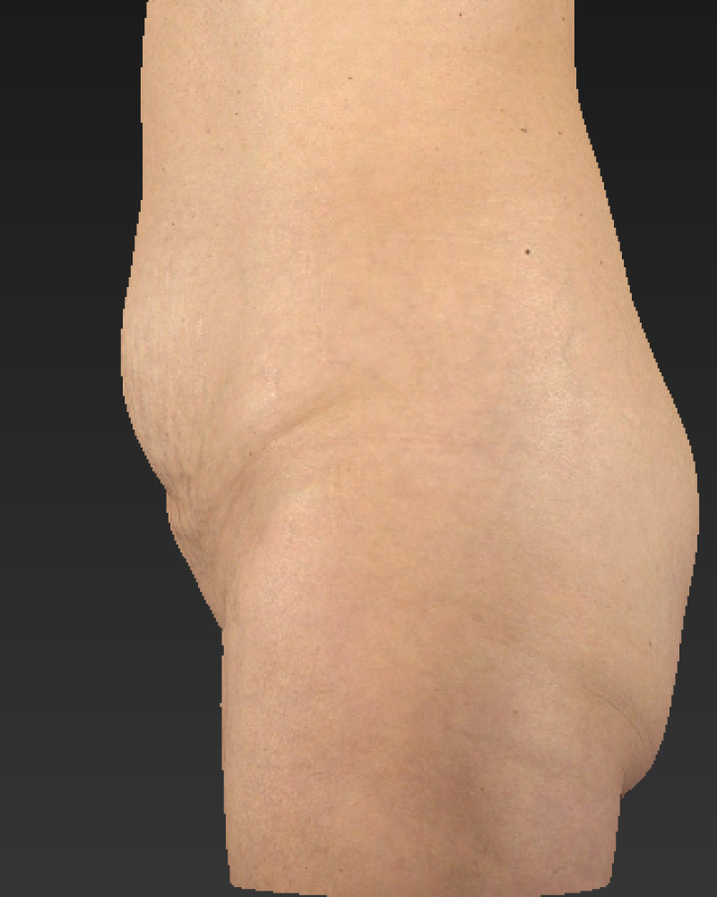 48 year old patient before abdominoplasty with lateral and posterior flank liposuction