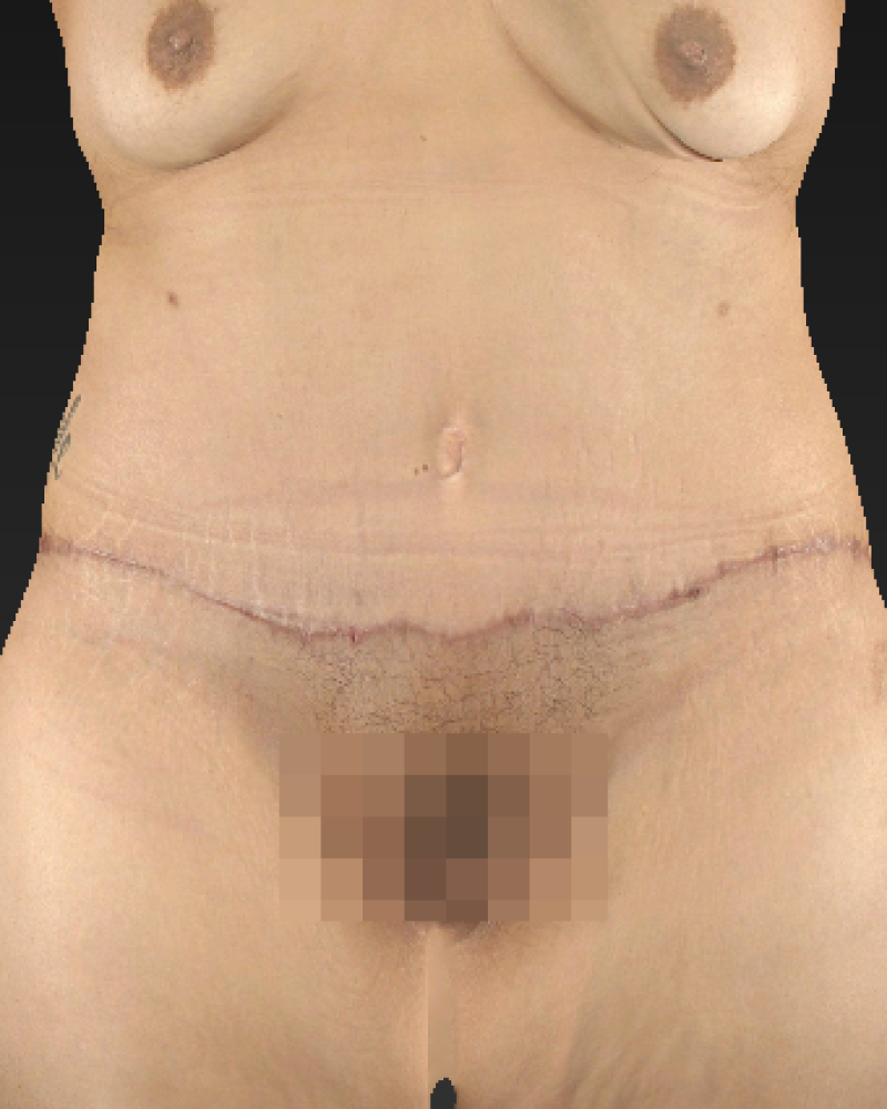 2 months post-op