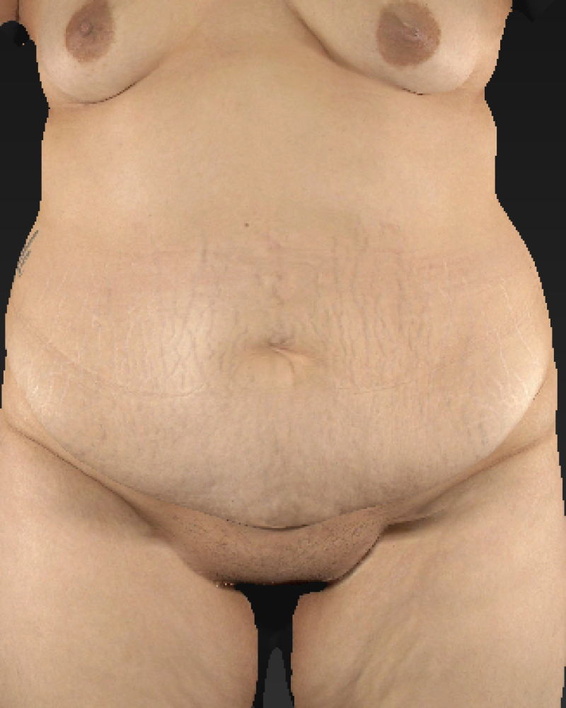 31 Year old patient before lipoabdominoplasty with lateral flank liposuction