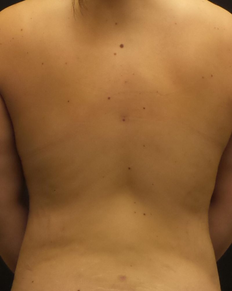 3 months post-op