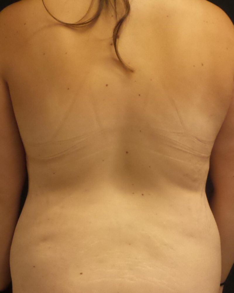 28 year old patient before liposuction of flanks and bra line, abdominoplasty and mons pubis reduction