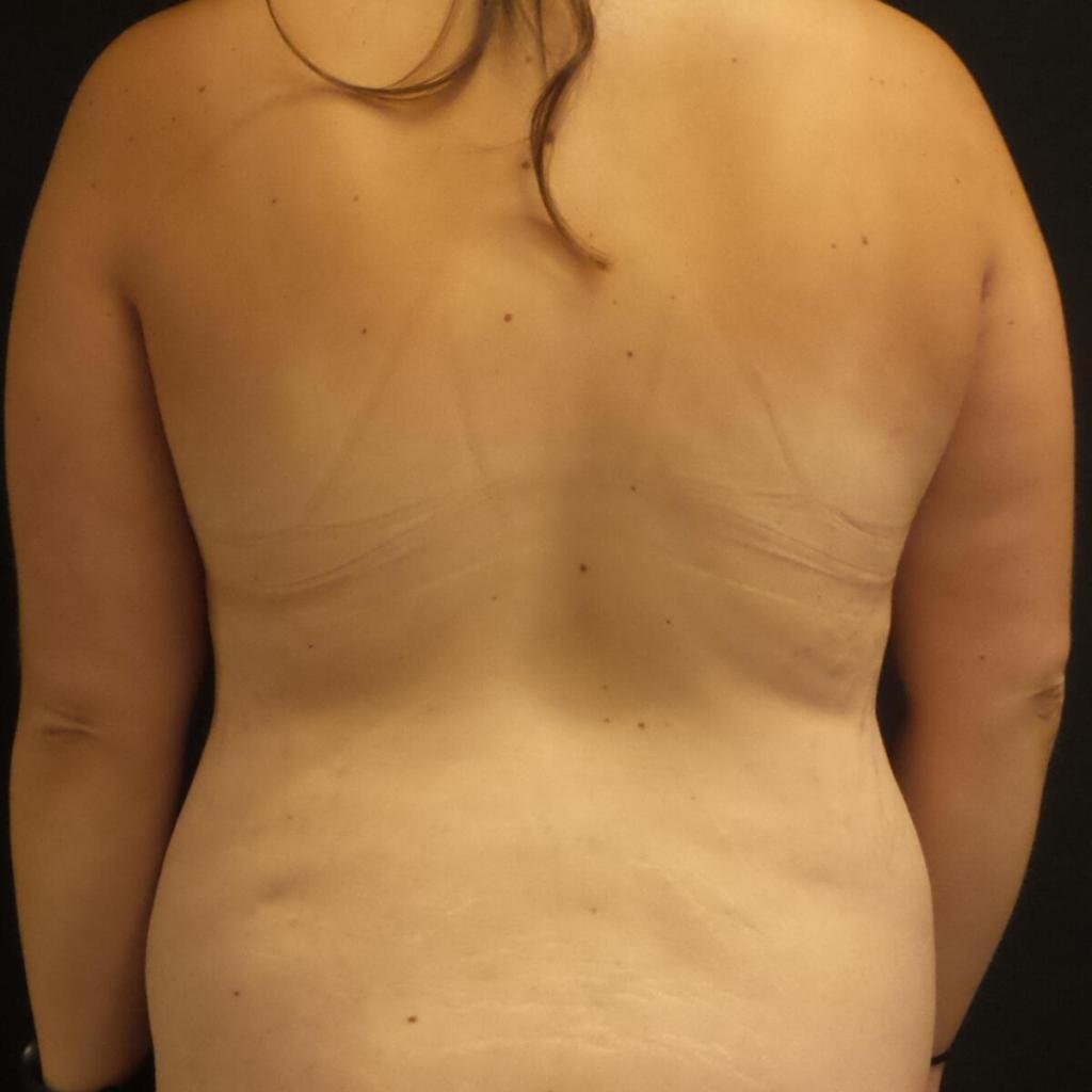 28 year old patient before liposuction of flanks and bra line, abdominoplasty and mons pubis reduction