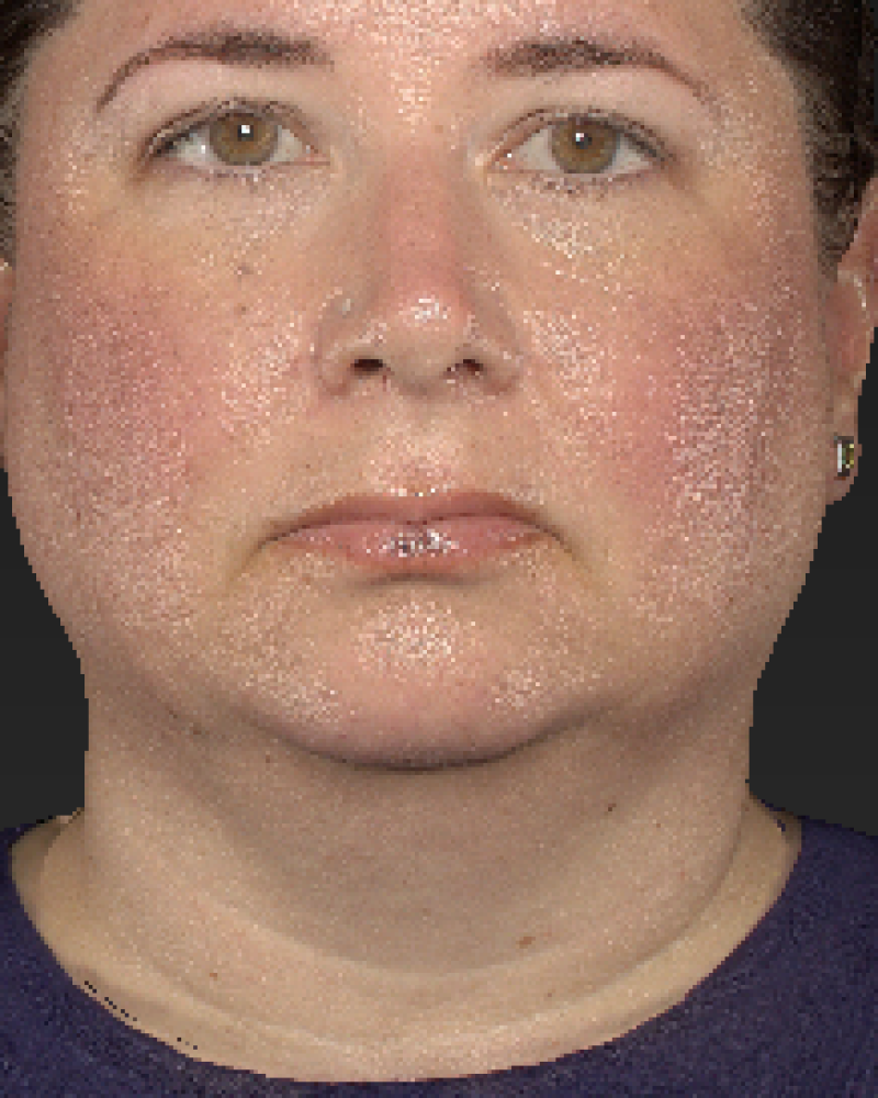 44 year old patient before liposuction of the neck