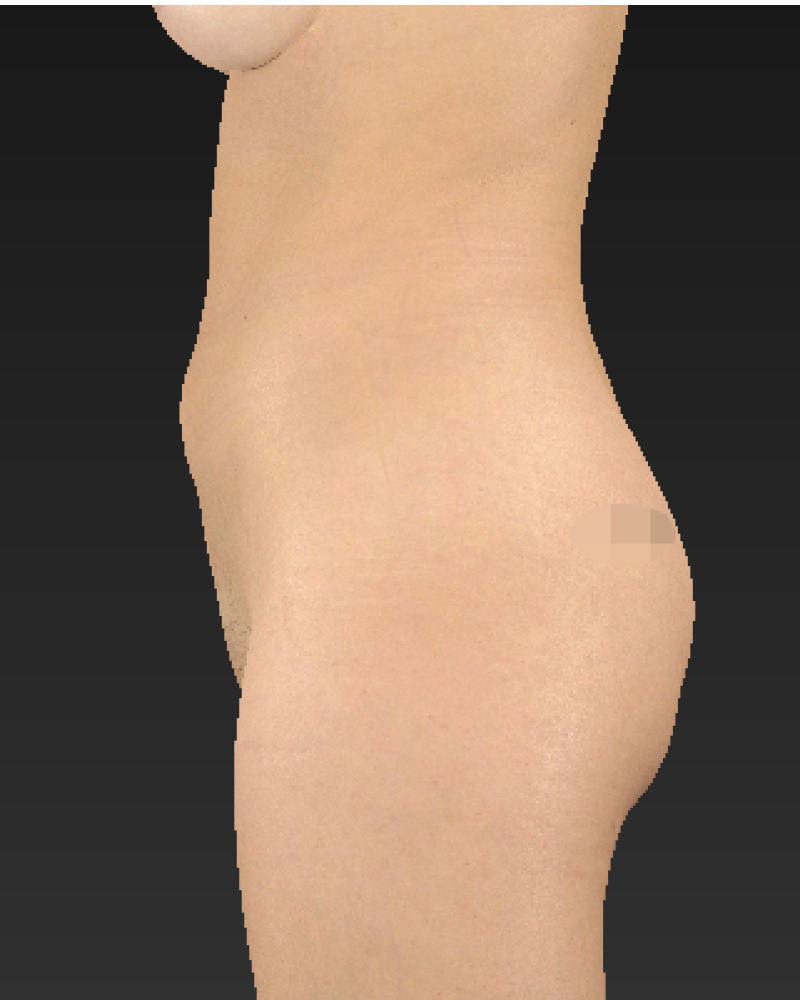 30 year old patient before liposuction of abdomen, flanks and medial thighs