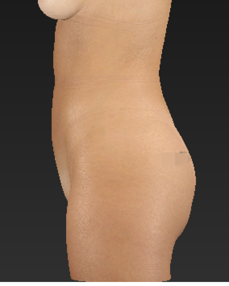 2 months post-op