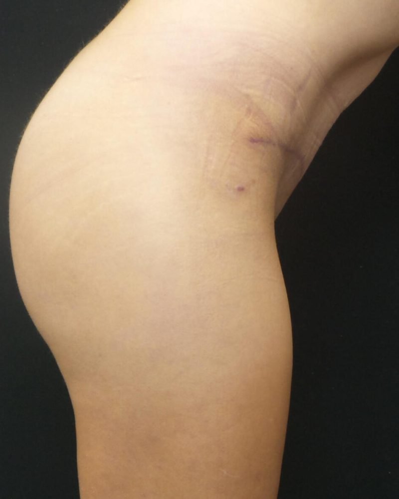 2 months post-op