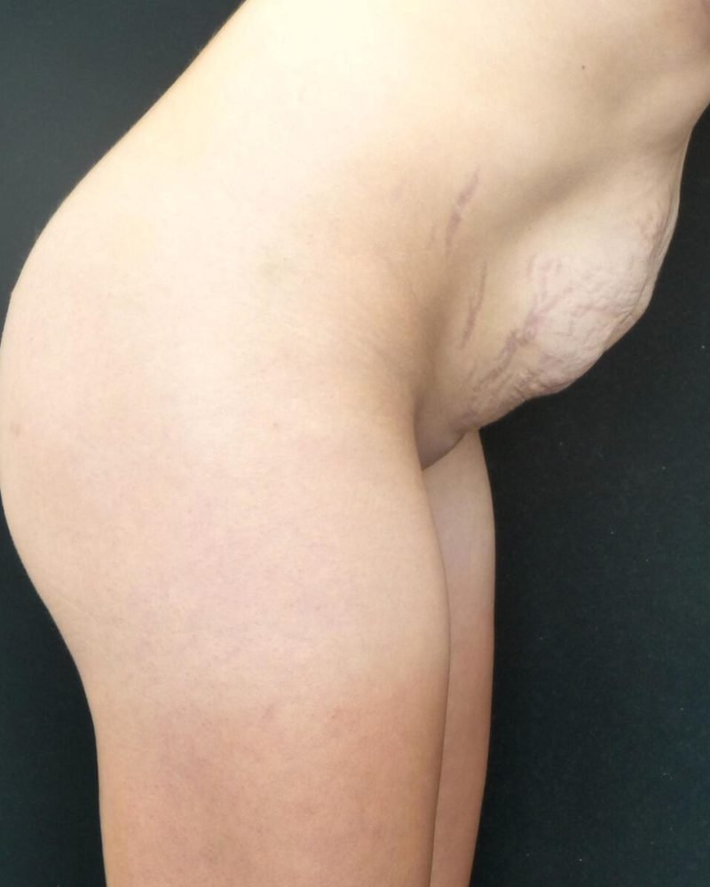 32 year old patient before standard abdominoplasty with flank liposuction